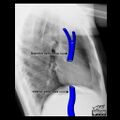 Cardiomediastinal anatomy on chest radiography (annotated images) (Radiopaedia 46331-50748 Q 1).jpeg