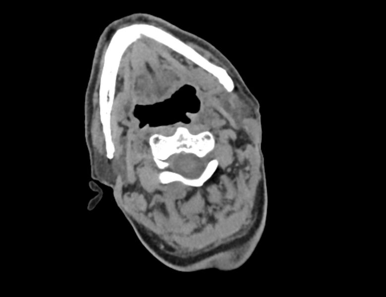 File:Carotid artery pseudoaneurysm (Radiopaedia 84030-99259 Axial non-contrast 9).jpg