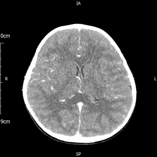 File:Cavernous sinus thrombosis (Radiopaedia 79414-92510 Axial Brain 114).jpg