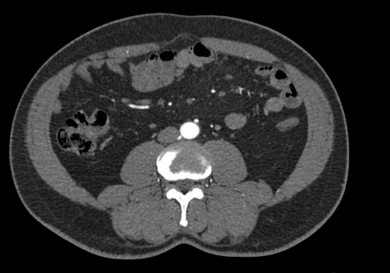 File:Celiac artery dissection (Radiopaedia 52194-58080 A 62).jpg