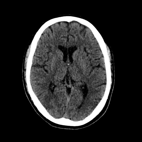 File:Central nervous system Langerhans cell histiocytosis (Radiopaedia 65728-74878 Axial non-contrast 28).jpg