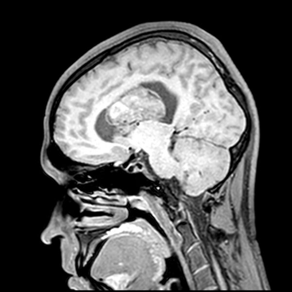 File:Central neurocytoma (Radiopaedia 79320-92380 Sagittal T1 148).jpg