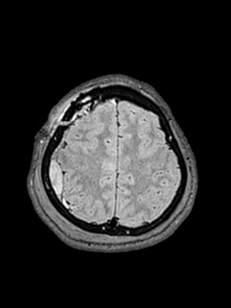 File:Central neurocytoma (Radiopaedia 79320-92381 Axial FLAIR 45).jpg