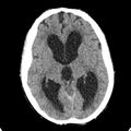 Cerebellar abscess secondary to mastoiditis (Radiopaedia 26284-26412 Axial non-contrast 77).jpg
