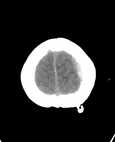 File:Cerebellar ependymoma complicated by post-operative subdural hematoma (Radiopaedia 83322-97737 Axial non-contrast 4).png