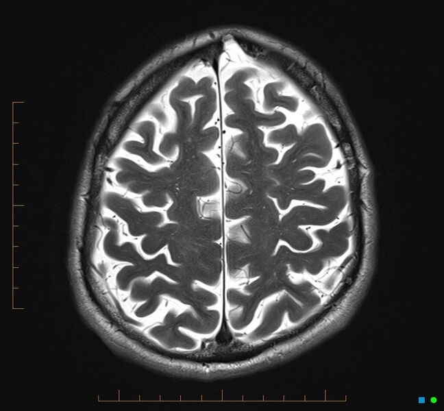 File:Cerebellar gangliocytoma (Radiopaedia 65377-74422 Axial T2 31).jpg