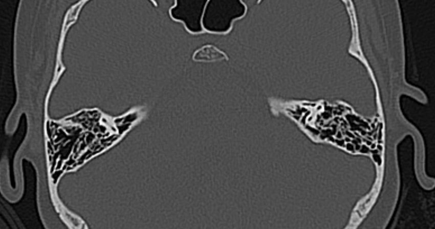Cerebellopontine angle lipoma (Radiopaedia 57303-64242 Axial bone window 43).jpg