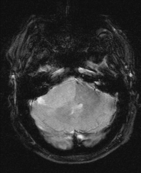 File:Cerebellopontine angle meningioma (Radiopaedia 24459-24764 Axial Gradient Echo 5).jpg