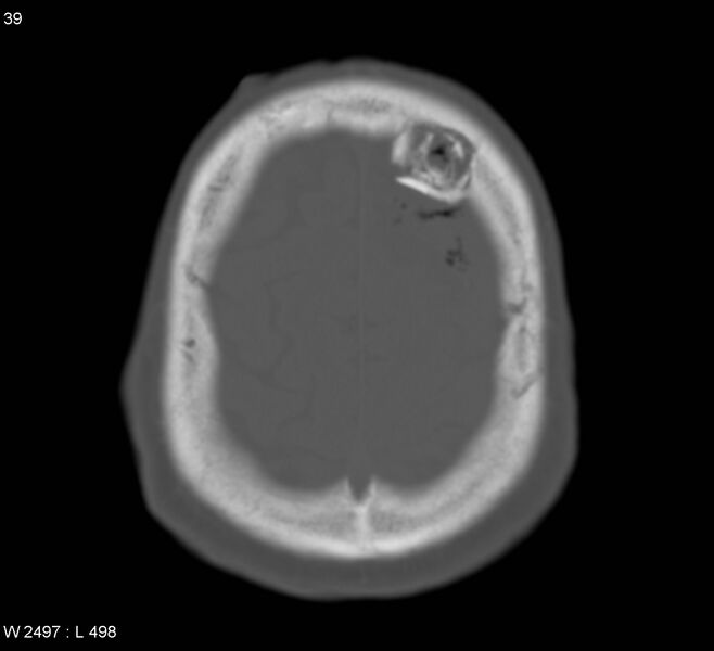 File:Cerebral abscess (Radiopaedia 5150-6933 Axial bone window 3).jpg