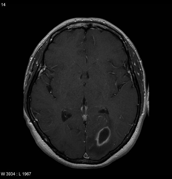 File:Cerebral abscess - shaggy borders (Radiopaedia 5492-7225 Axial T1 C+ 1).jpg