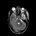 Cerebral abscess post cardiac surgery (Radiopaedia 27244-27420 Axial T2 7).jpg