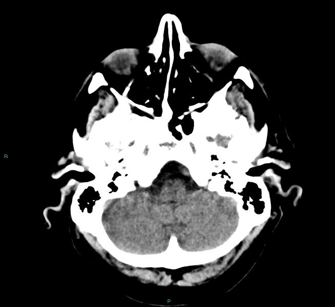 File:Cerebral amyloid angiopathy-associated lobar intracerebral hemorrhage (Radiopaedia 58376-65511 Axial non-contrast 46).jpg
