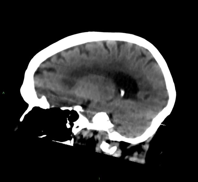 File:Cerebral amyloid angiopathy-associated lobar intracerebral hemorrhage (Radiopaedia 58377-65514 B 33).jpg