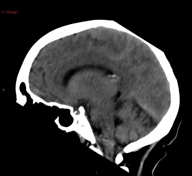 File:Cerebral amyloid angiopathy-associated lobar intracerebral hemorrhage (Radiopaedia 58378-65518 C 36).jpg