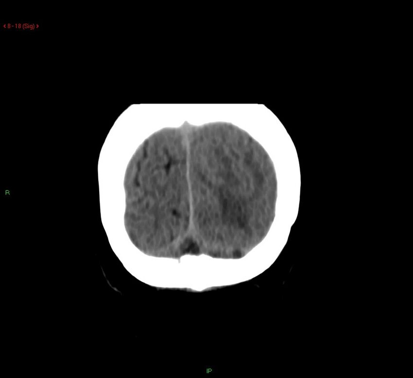 Cerebral amyloid angiopathy-associated lobar intracerebral hemorrhage (Radiopaedia 58378-65518 Coronal non-contrast 18).jpg