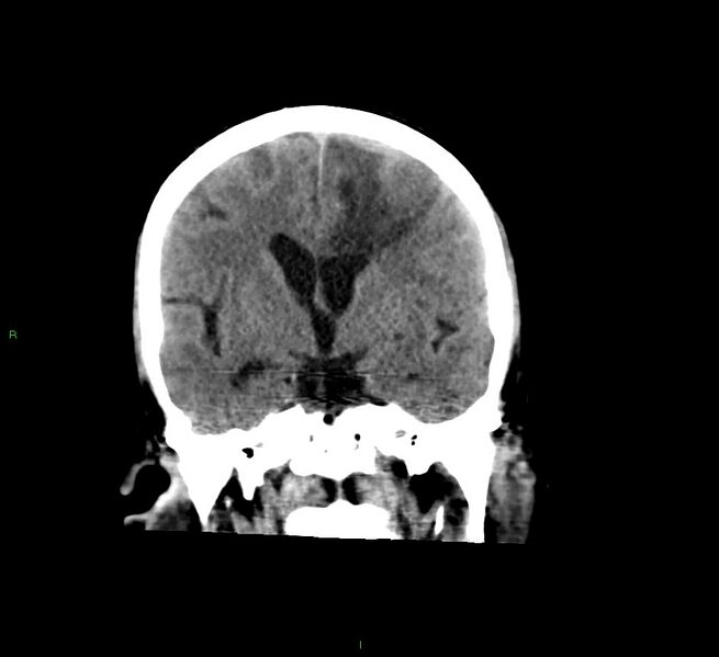 File:Cerebral amyloid angiopathy-associated lobar intracerebral hemorrhage (Radiopaedia 58529-65681 Coronal non-contrast 37).jpg