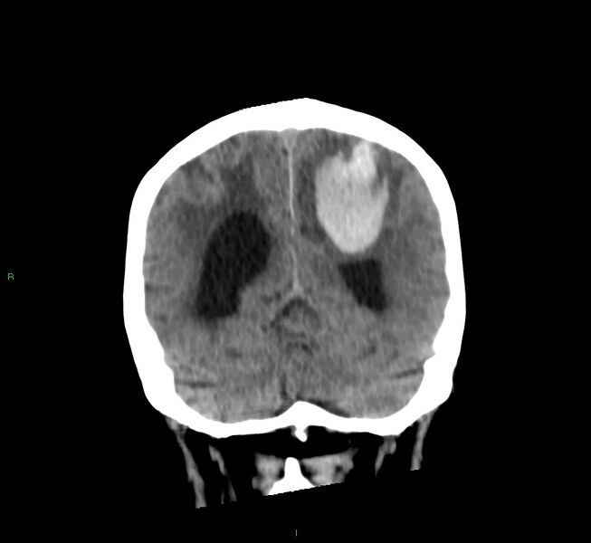 File:Cerebral amyloid angiopathy-associated lobar intracerebral hemorrhage (Radiopaedia 58530-65688 Coronal non-contrast 21).jpg