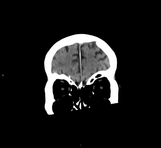 File:Cerebral amyloid angiopathy-associated lobar intracerebral hemorrhage (Radiopaedia 58530-65688 Coronal non-contrast 55).jpg