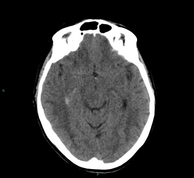 File:Cerebral amyloid angiopathy-associated lobar intracerebral hemorrhage (Radiopaedia 58566-65730 Axial non-contrast 31).jpg