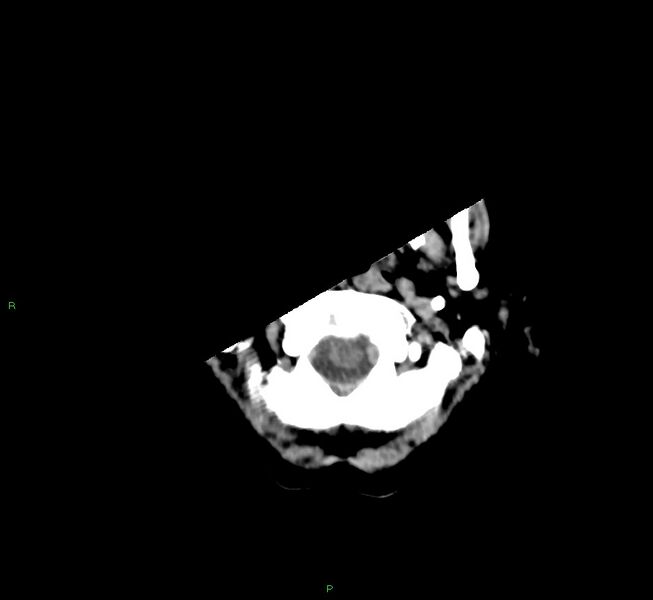 File:Cerebral amyloid angiopathy-associated lobar intracerebral hemorrhage (Radiopaedia 58754-65975 Axial non-contrast 55).jpg