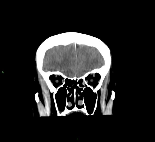 File:Cerebral amyloid angiopathy-associated lobar intracerebral hemorrhage (Radiopaedia 58756-65977 Coronal non-contrast 51).jpg
