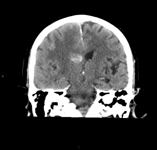 File:Cerebral amyloid angiopathy-associated lobar intracerebral hemorrhage (Radiopaedia 59356-66716 Coronal non-contrast 33).jpg