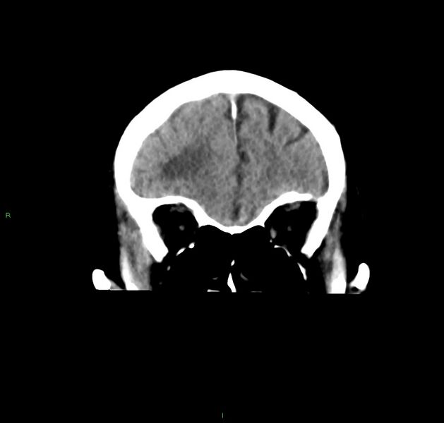 File:Cerebral amyloid angiopathy-associated lobar intracerebral hemorrhage (Radiopaedia 59356-66716 Coronal non-contrast 51).jpg