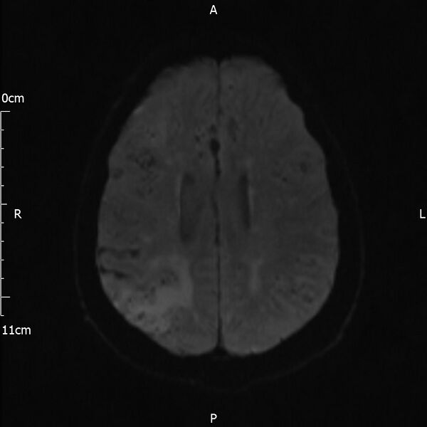 File:Cerebral amyloid angiopathy related inflammation (Radiopaedia 72772-83415 Axial DWI 39).jpg