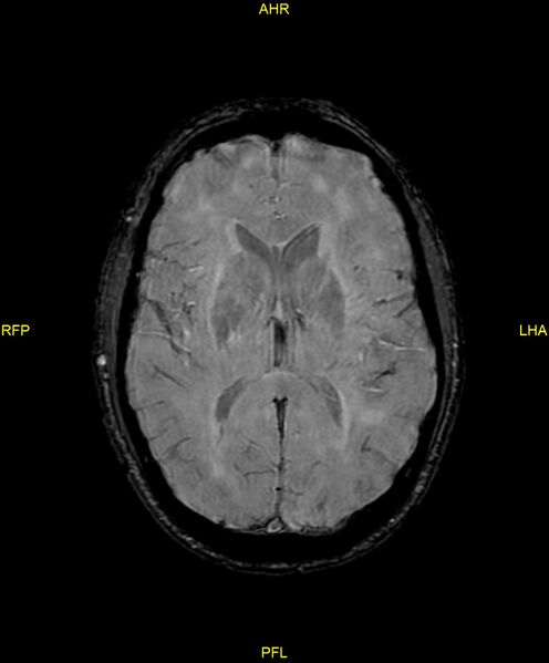 File:Cerebral autosomal dominant arteriopathy with subcortical infarcts and leukoencephalopathy (CADASIL) (Radiopaedia 86108-102054 Axial SWI 61).jpg