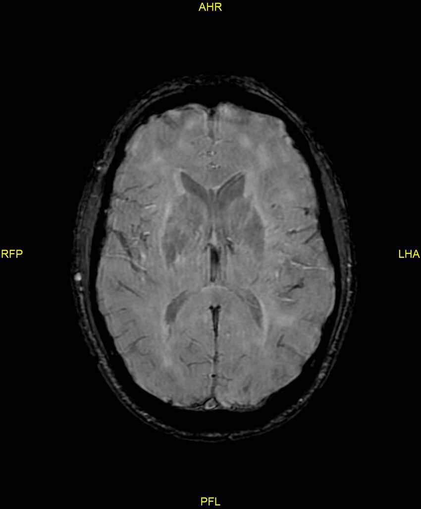 Cerebral autosomal dominant arteriopathy with subcortical infarcts and leukoencephalopathy (CADASIL) (Radiopaedia 86108-102054 Axial SWI 61).jpg