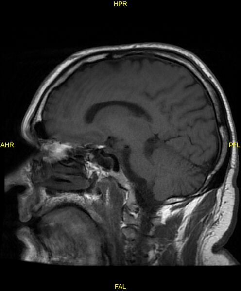 File:Cerebral autosomal dominant arteriopathy with subcortical infarcts and leukoencephalopathy (CADASIL) (Radiopaedia 86108-102054 Sagittal T1 12).jpg