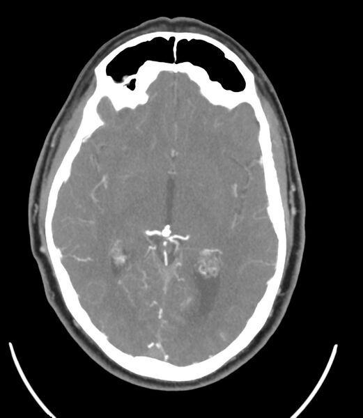 File:Cerebral dural venous sinus thrombosis (Radiopaedia 86514-102576 A 53).jpg