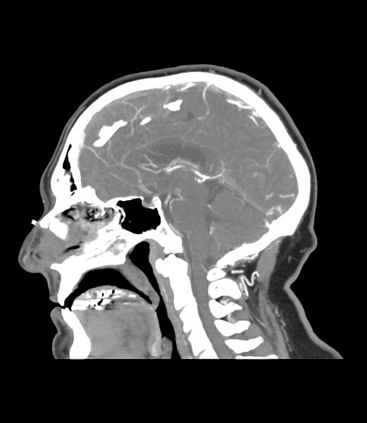 File:Cerebral dural venous sinus thrombosis (Radiopaedia 86514-102576 C 29).jpg