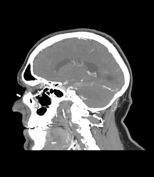 File:Cerebral dural venous sinus thrombosis (Radiopaedia 86514-102576 C 36).jpg