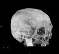 Cerebral hemorrhagic contusions (Radiopaedia 23145-23188 3D MIP 4).jpg