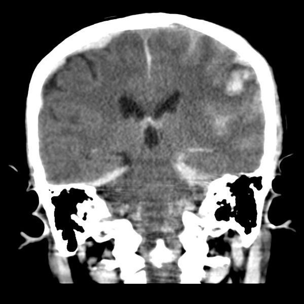 File:Cerebral hemorrhagic contusions (Radiopaedia 23145-23188 Coronal non-contrast 26).jpg
