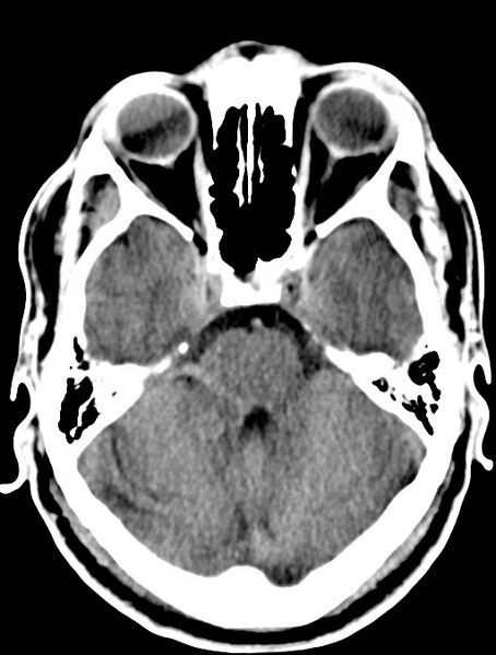 File:Cerebral venous angioma (Radiopaedia 69959-79977 Axial non-contrast 11).jpg