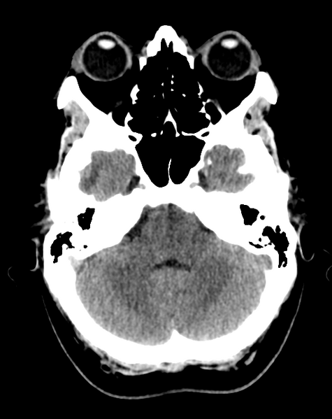 File:Cerebral venous infarct related to dural venous sinus thromboses (Radiopaedia 35292-36803 AXIAL THICK 6).png