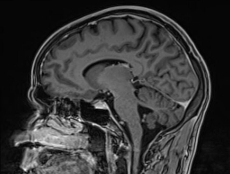 File:Cerebral venous thrombosis (Radiopaedia 71207-81504 Sagittal T1 C+ 27).jpg