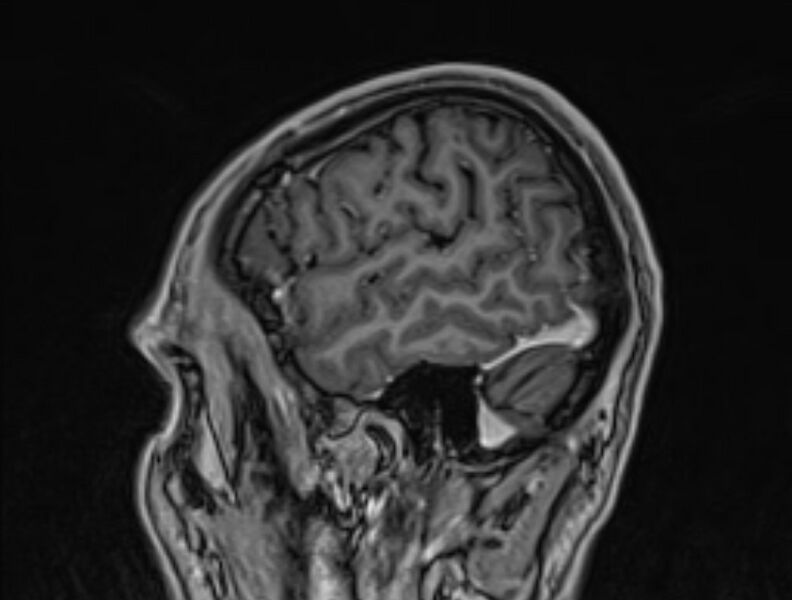 File:Cerebral venous thrombosis (Radiopaedia 71207-81504 Sagittal T1 C+ 7).jpg