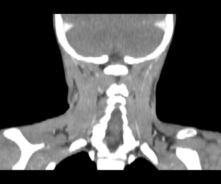 File:Cervical cystic lymphangioma (Radiopaedia 63655-72332 Coronal + contrast 28).jpg