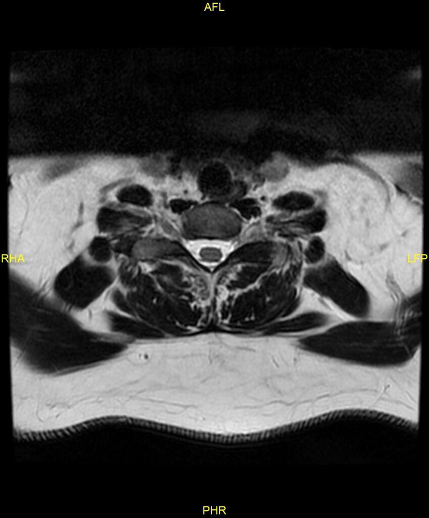 Cervical disc protrusion (Radiopaedia 87147-103415 Axial T2 65).jpg