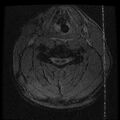 Cervical flexion teardrop fracture with cord hemorrhage (Radiopaedia 32497-33455 Axial Gradient Echo 14).jpg