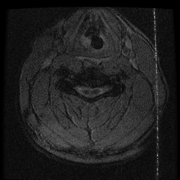 File:Cervical flexion teardrop fracture with cord hemorrhage (Radiopaedia 32497-33455 Axial Gradient Echo 14).jpg