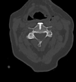 Cervical spine ACDF loosening (Radiopaedia 48998-54070 Axial bone window 28).png
