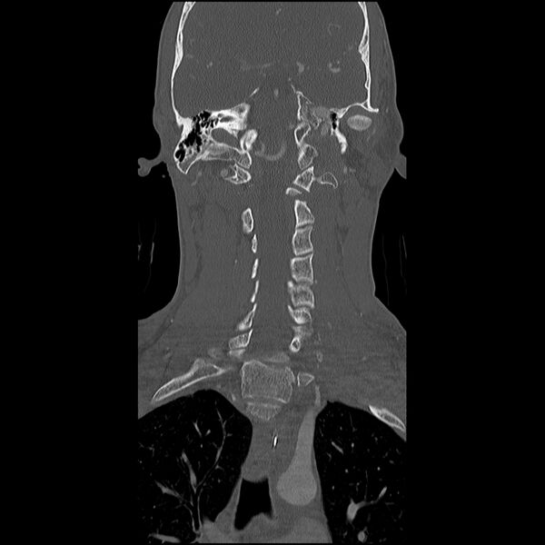 File:Cervical spine fractures with vertebral artery dissection (Radiopaedia 32135-33078 Coronal bone window 15).jpg