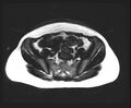 Cesarean section scar endometrioma (Radiopaedia 56569-63297 Axial T1 17).jpg