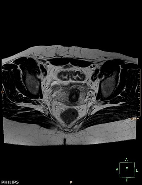 File:Cesarian scar endometriosis (Radiopaedia 68495-78066 Axial T2 15).jpg