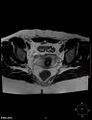 Cesarian scar endometriosis (Radiopaedia 68495-78066 Axial T2 15).jpg
