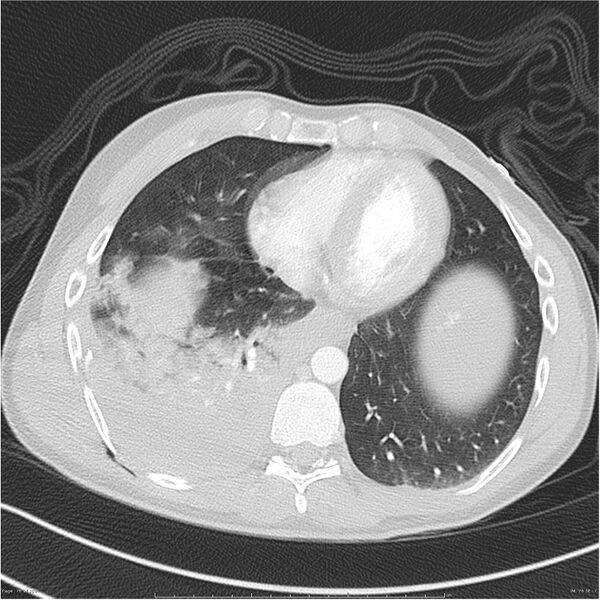 File:Chest and abdomen multi-trauma (Radiopaedia 26294-26425 lung window 76).jpg
